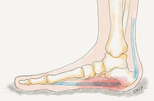 【足底腱膜炎① 症状と原因】朝の一歩目が痛い...それ、足底腱膜炎かもしれません