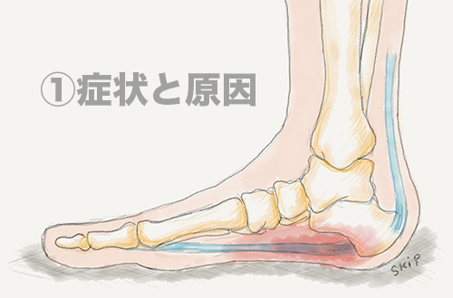 【足底腱膜炎① 症状と原因】朝の一歩目が痛い...それ、足底腱膜炎かもしれません